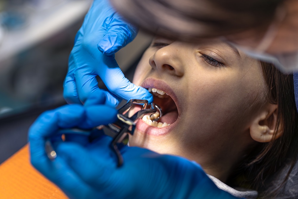 Dental Sealants Step by Step: What Happens During the Procedure?